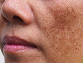 Routine chăm sóc da nám nội tiết đúng cách giúp da ổn định và sáng khỏe 