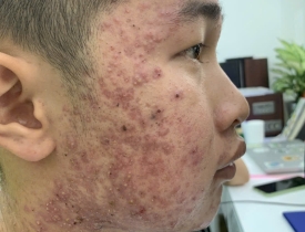 Da mụn mãi không hết? 7 nguyên nhân sâu bên trong mà 90% người bị mụn đều bỏ qua