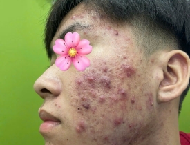 Lấy nhân mụn & phục hồi da sau khi lấy mụn