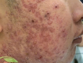 Vì sao da nam giới dễ bị thâm mụn? Giải pháp chăm sóc da từ Đông y